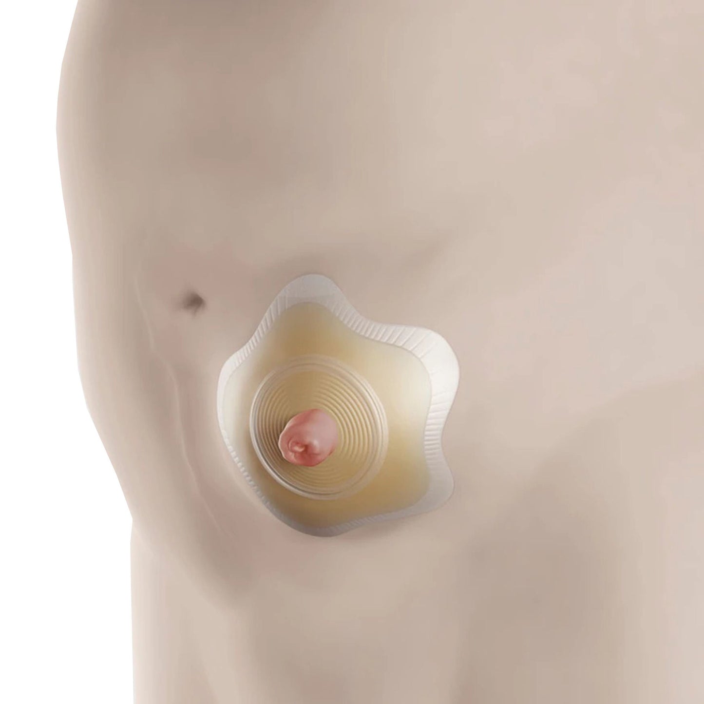 SenSura® Mio Click Convex Flip Ostomy Barrier, Stomas, Red Match