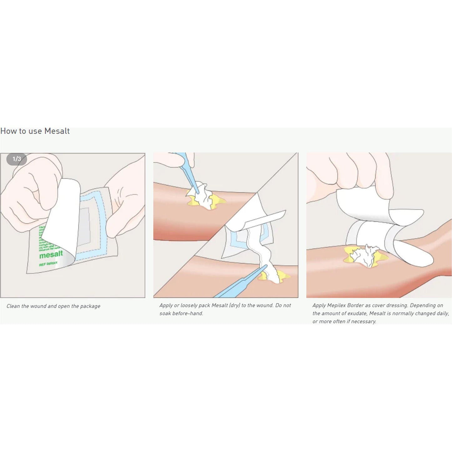 Mesalt® Sodium Chloride Impregnated Dressing