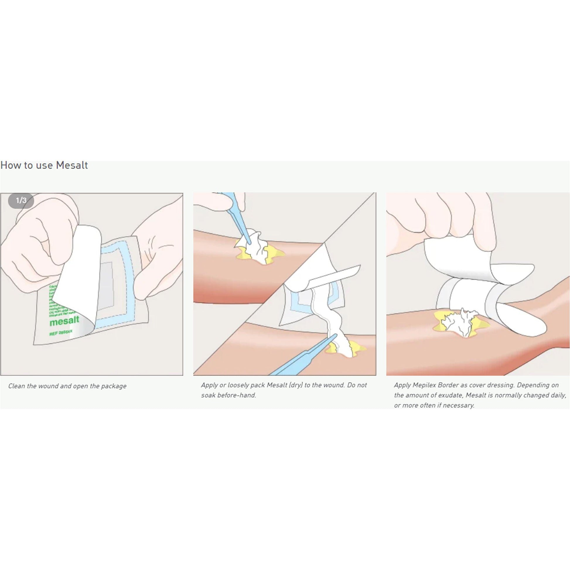 Mesalt® Sodium Chloride Impregnated Dressing