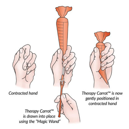 AliMed® Original Therapy Carrot™ Finger Contracture Orthosis Kit