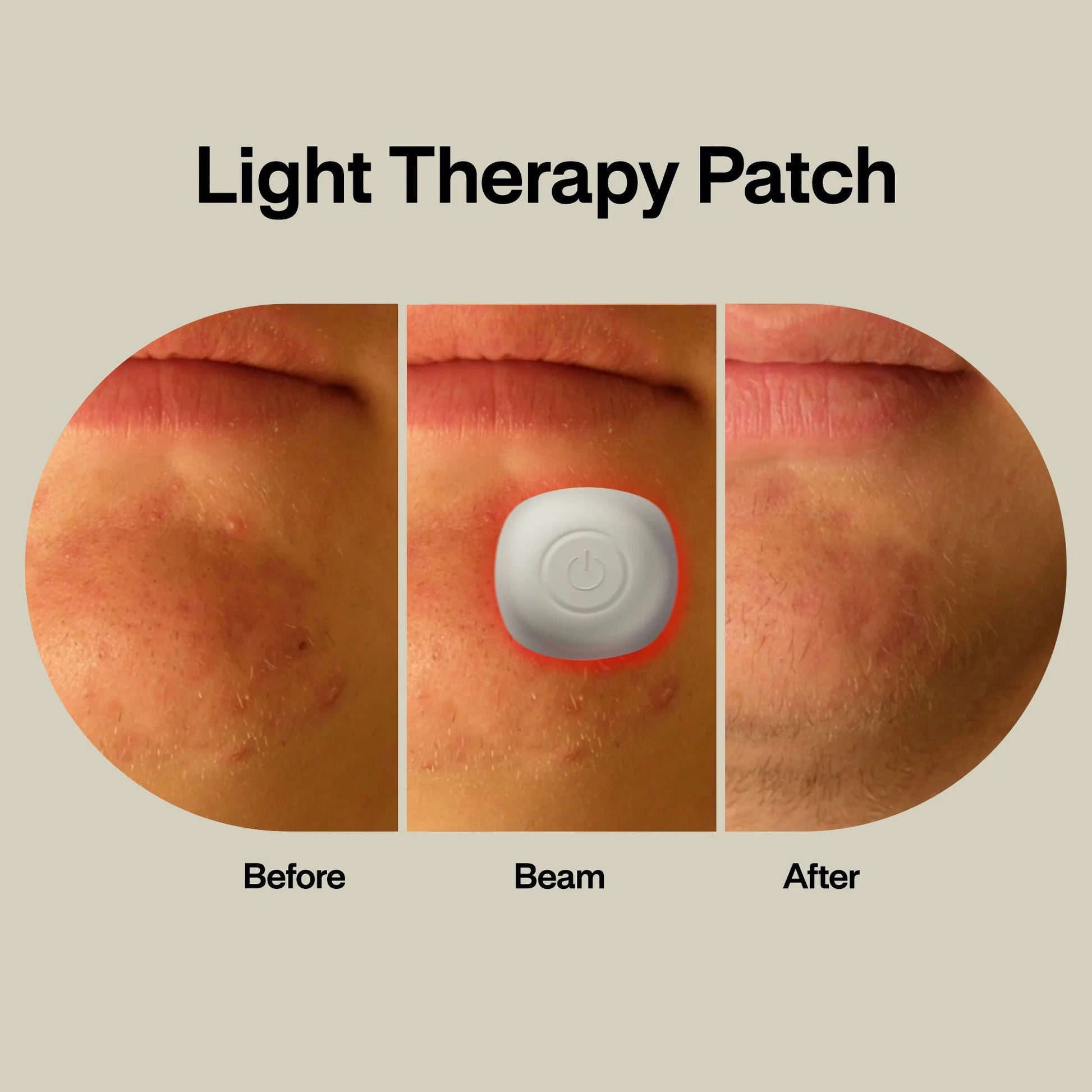 LAB Acne Light Therapy Patch Acne Treatments with Lightpod and Four Hydrogrips