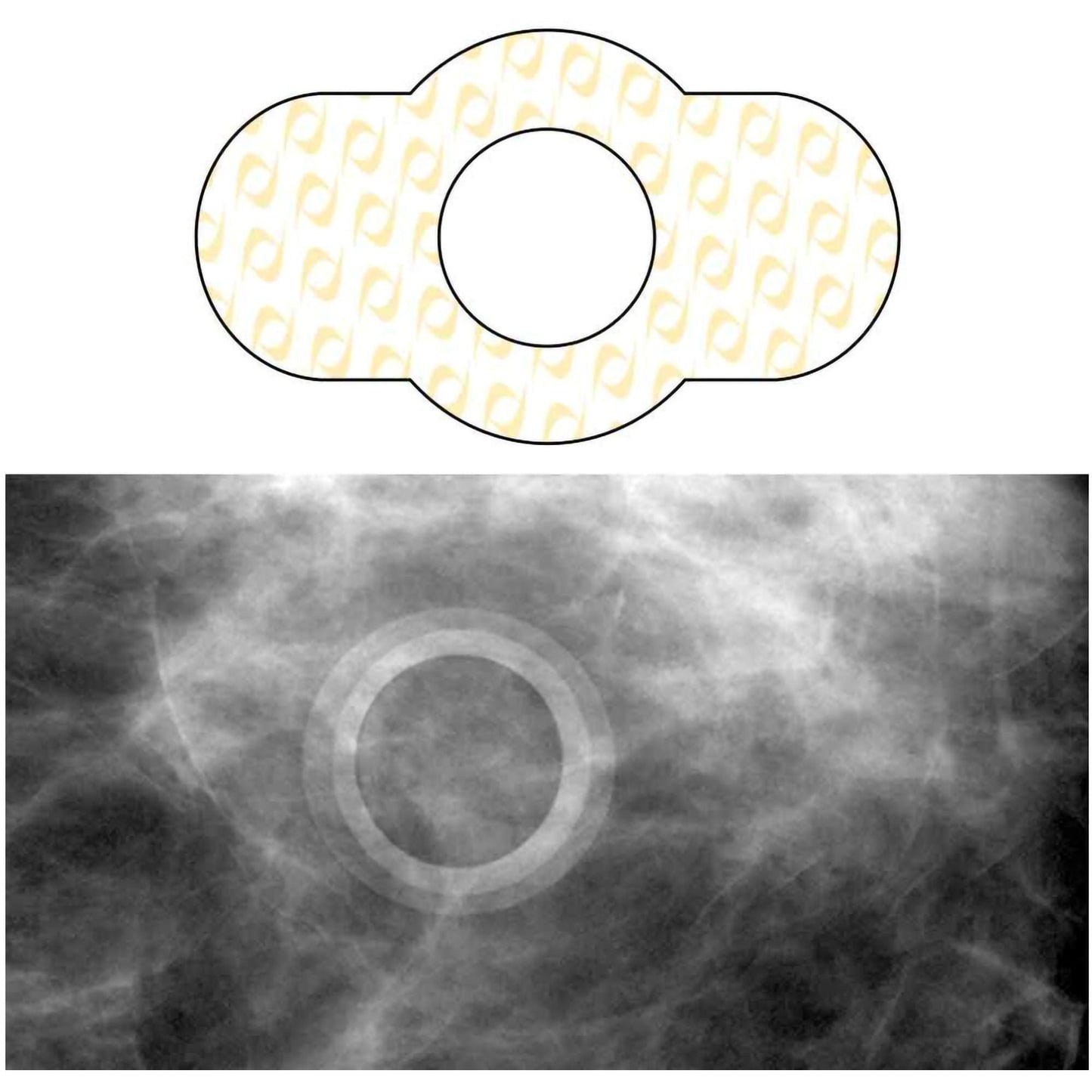 Spee-D-Ring™ Skin Marker