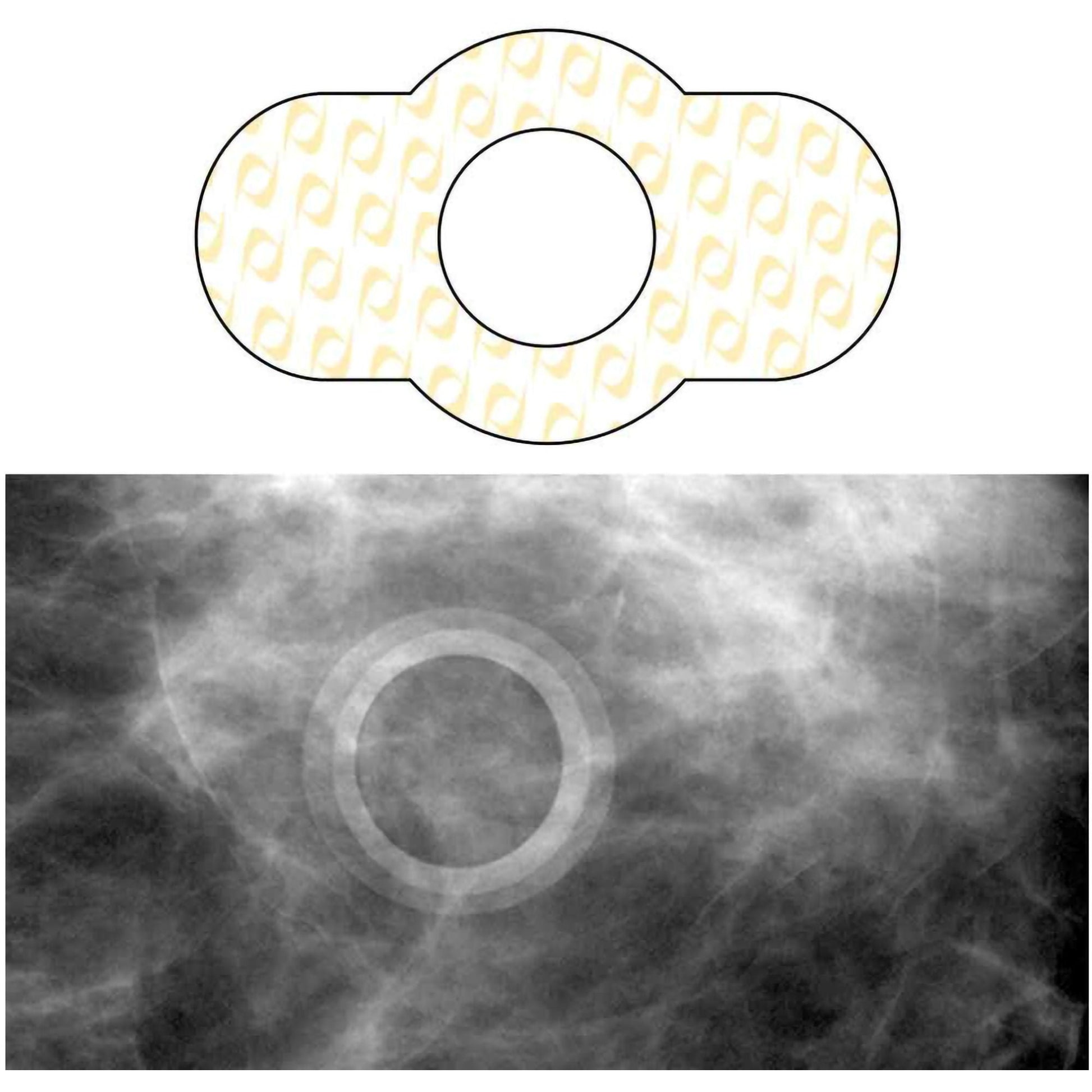 Spee-D-Ring™ Skin Marker
