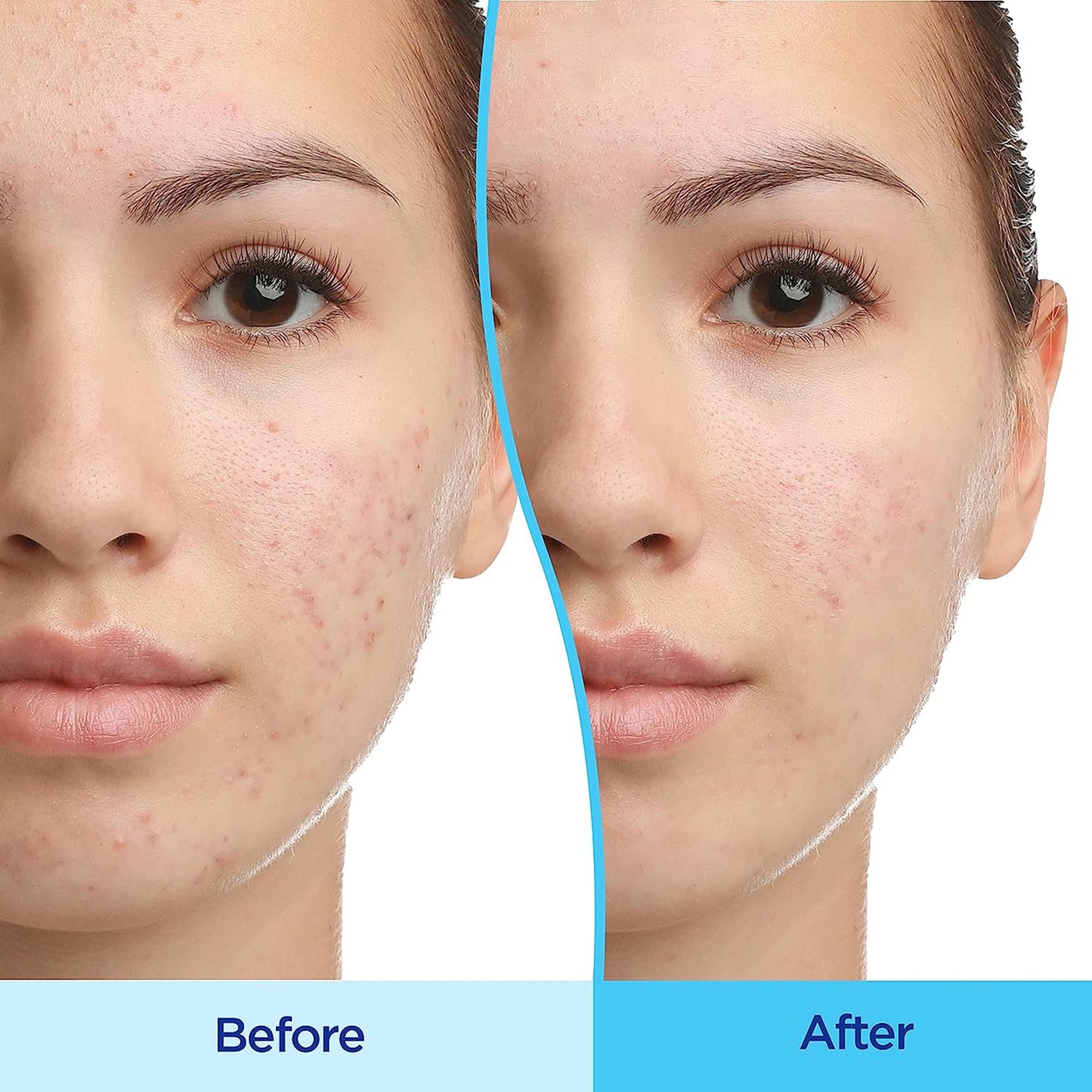 Differin® 0.1% Adapalene Gel Acne Treatment, Pump Bottle