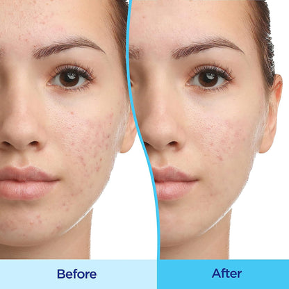 Differin® 0.1% Adapalene Gel Acne Treatment, Pump Bottle