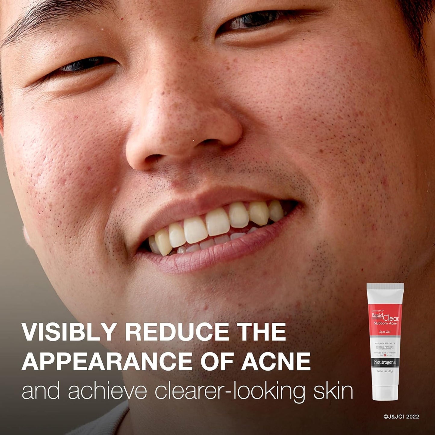 Neutrogena® Rapid Clear Stubborn Acne Spot 10% Benzoyl Peroxide Gel