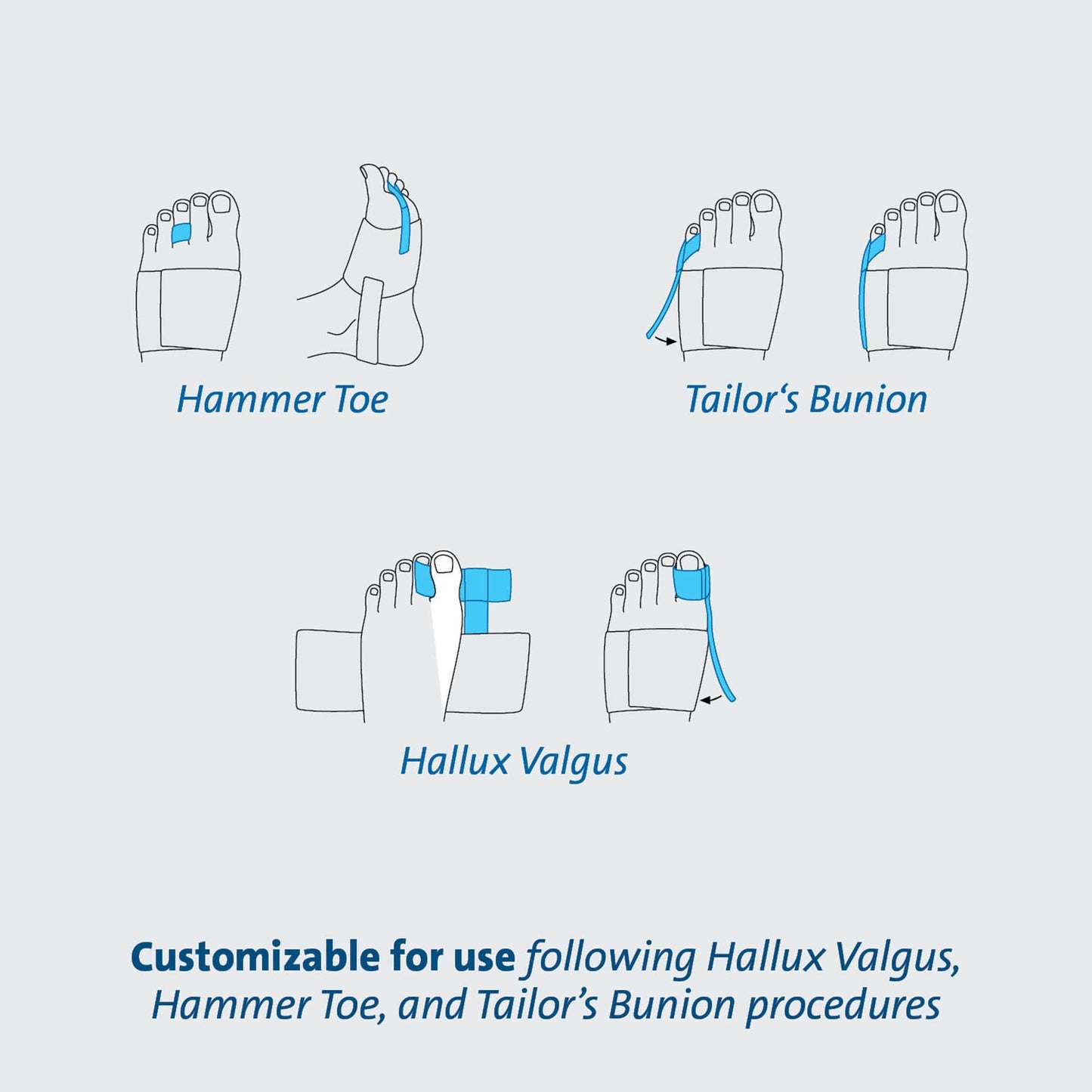 TAS™ Toe Splint