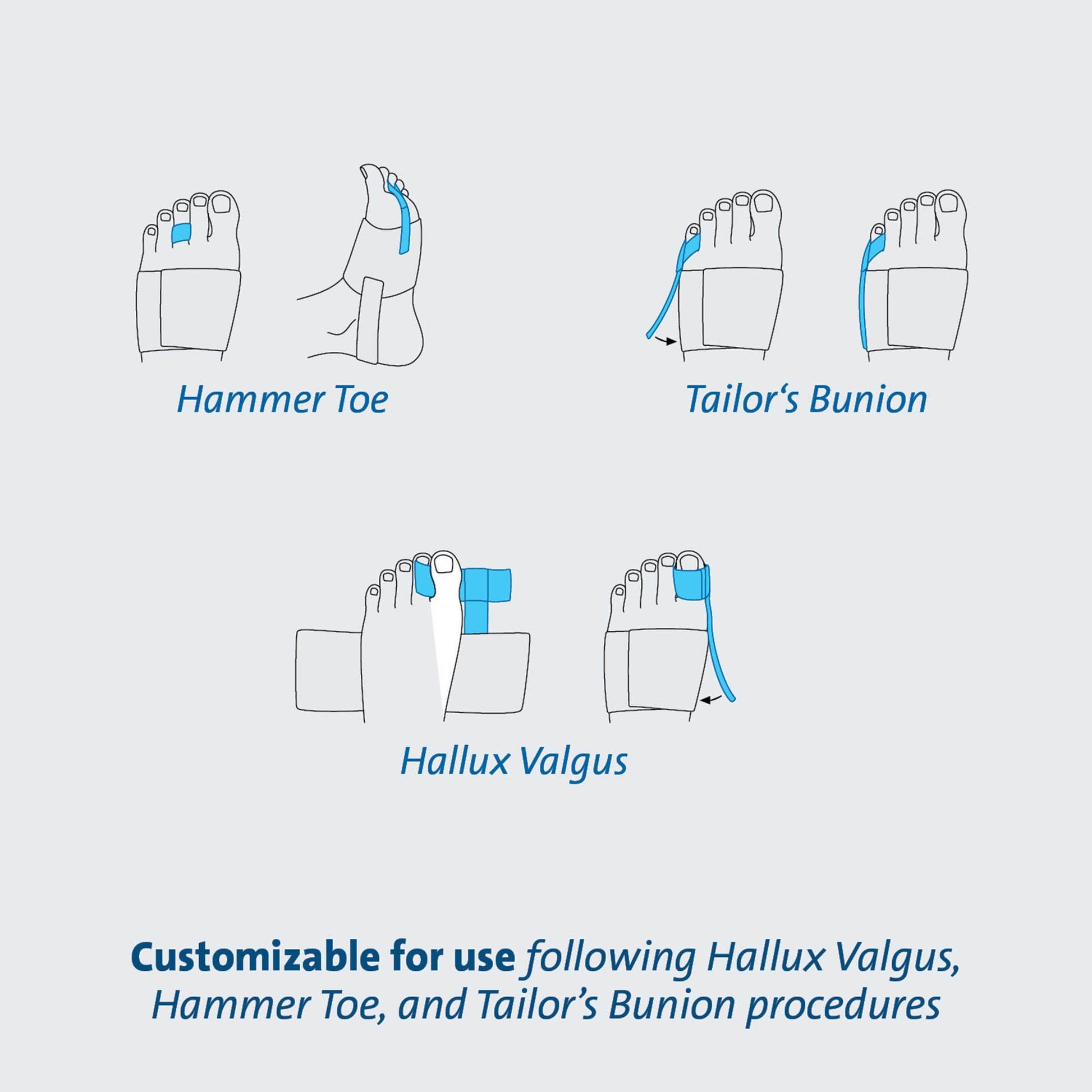TAS™ Toe Splint