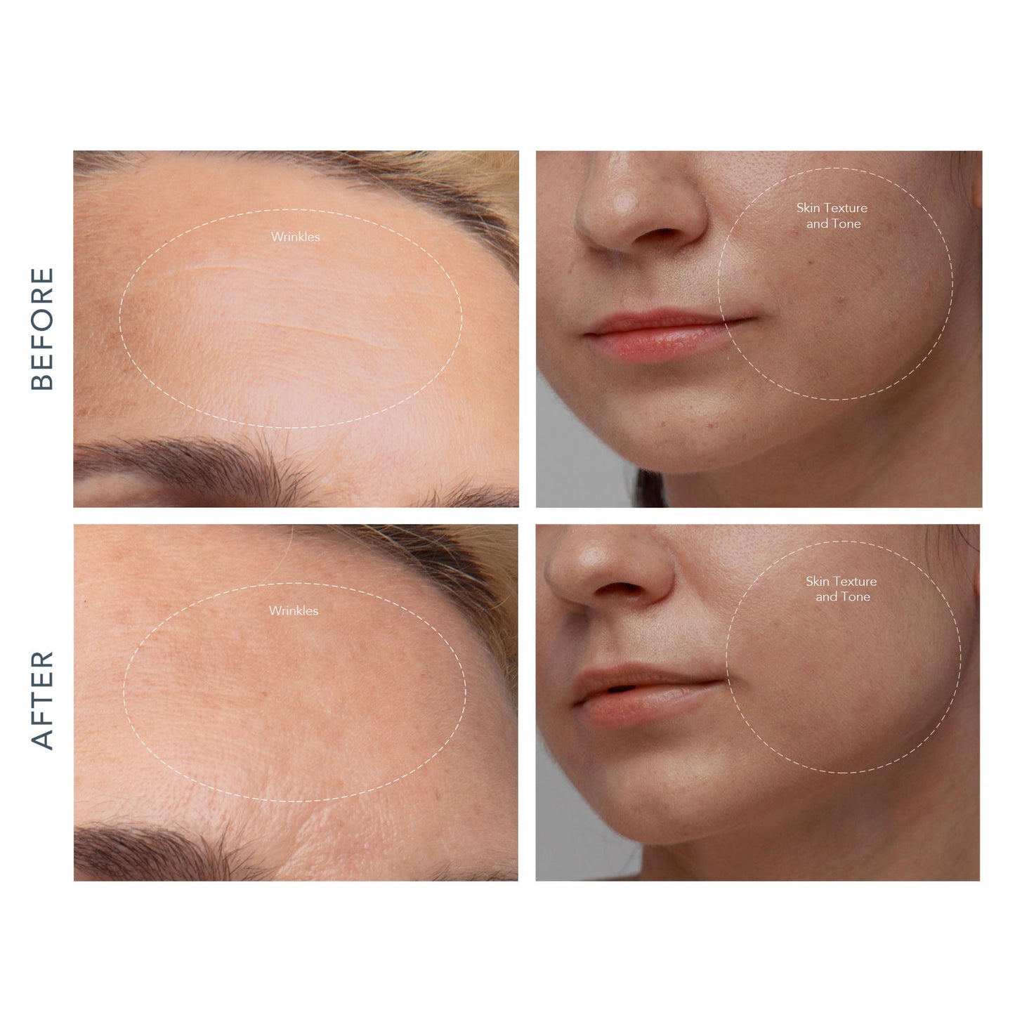 KIWI™ derma Microdermabrasion Pore Vacuum