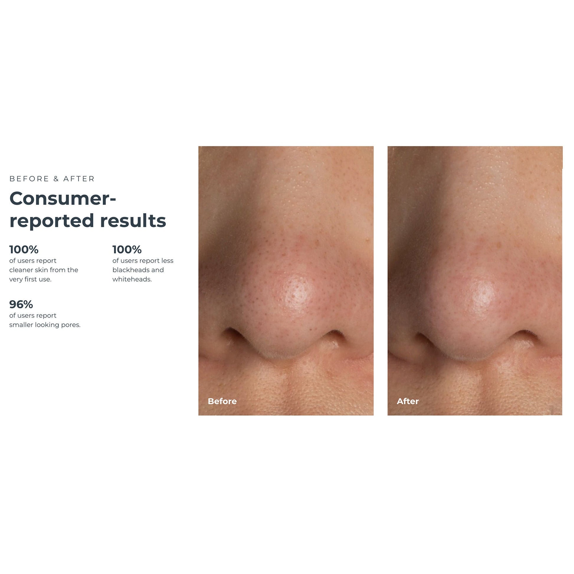 KIWI™ Blackhead Remover Pore Vaccum